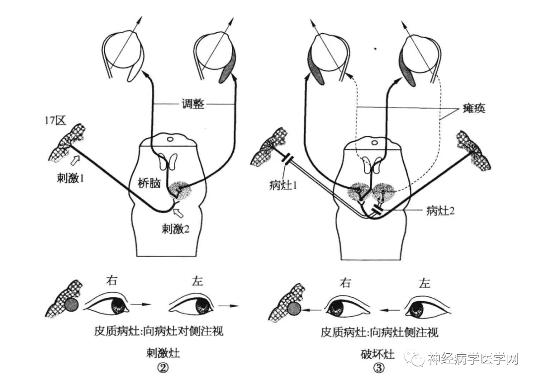 眼球运动障碍怎么训练_眼球运动障碍_眼球障碍运动能治好吗