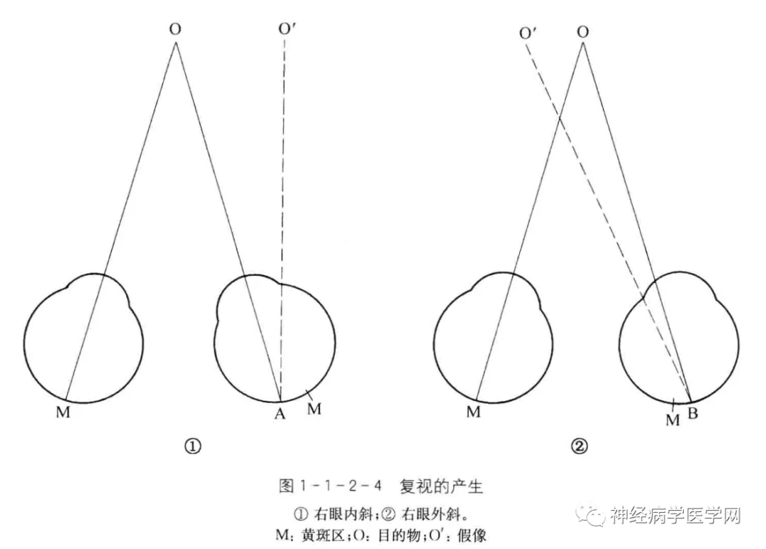 眼球障碍运动能治好吗_眼球运动障碍_眼球运动障碍怎么训练