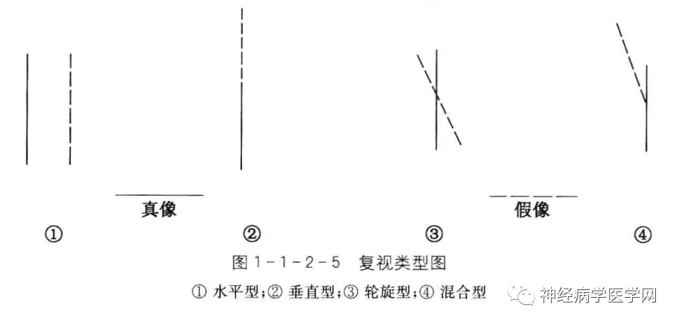 眼球运动障碍怎么训练_眼球运动障碍_眼球障碍运动能治好吗