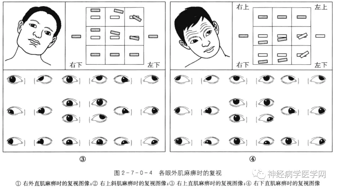 眼球障碍运动能治好吗_眼球运动障碍怎么训练_眼球运动障碍