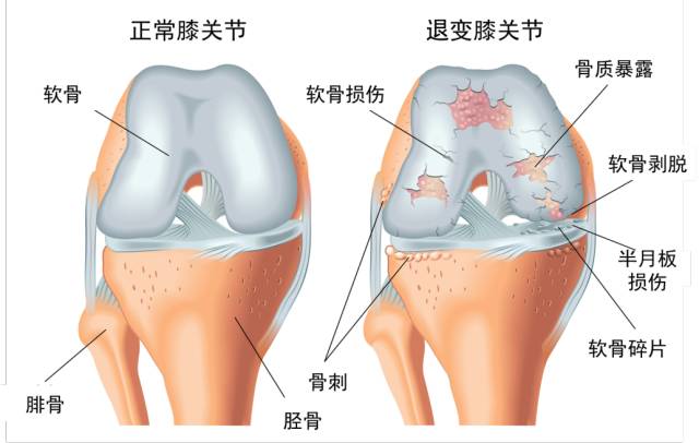 髌骨运动_运动髌骨损伤怎么办_运动髌骨带有用吗