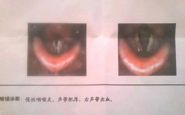 声带运动障碍可以根治吗_声带运动受限症状_声带运动