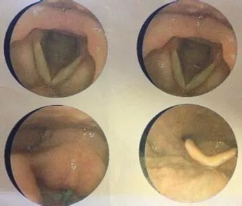 声带运动障碍可以根治吗_声带运动受限症状_声带运动